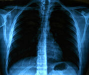 X-Ray Image Of Human Healthy Chest